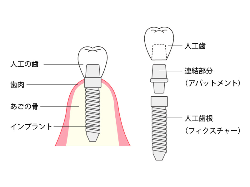 インプラントの治療方法