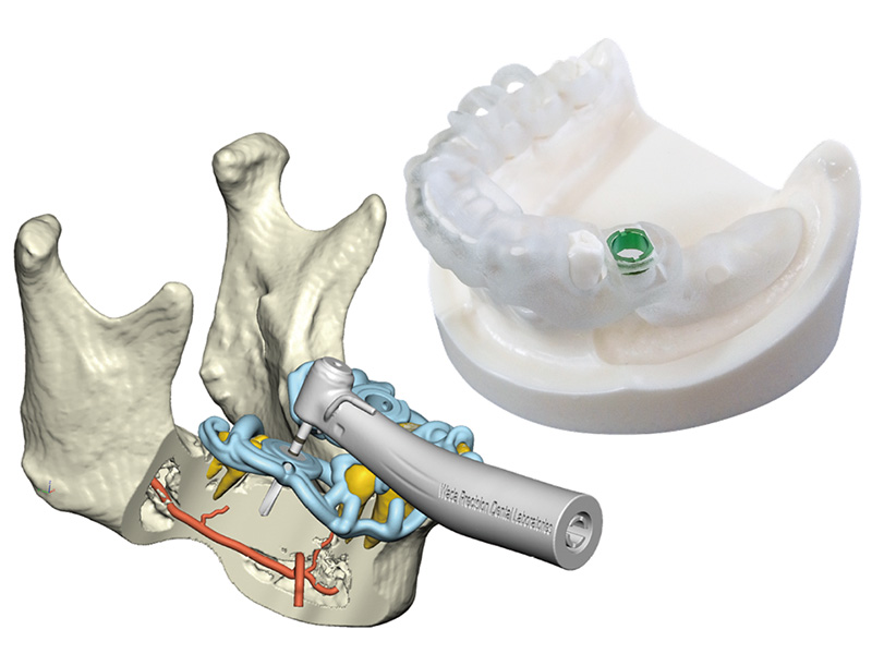 BioNaによる分析とサージカルガイド作成