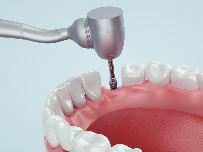 手術（インプラント埋入）
