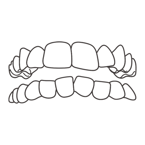 前歯のデコボコ