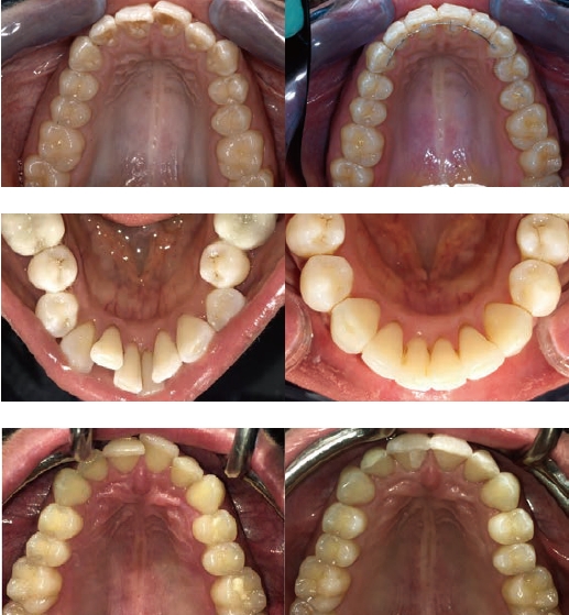 歯列の拡大・縮小