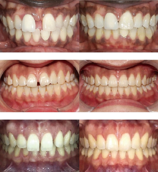 軽度のスペースの閉鎖