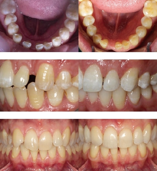 補綴用スペースの確保