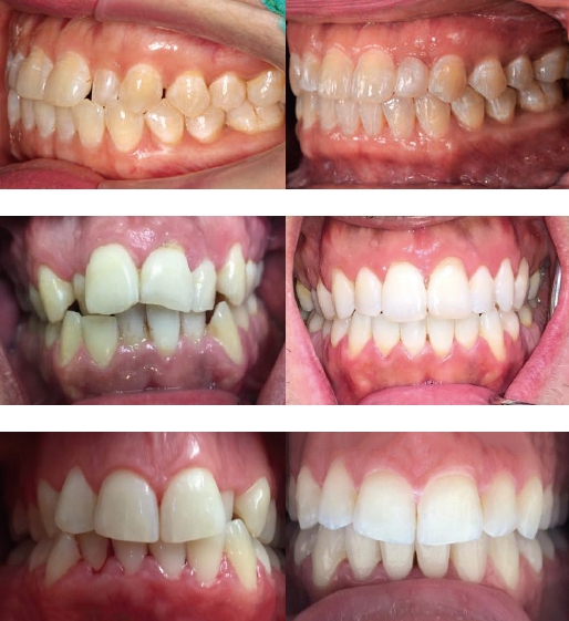 2歯までの前歯部クロスバイト